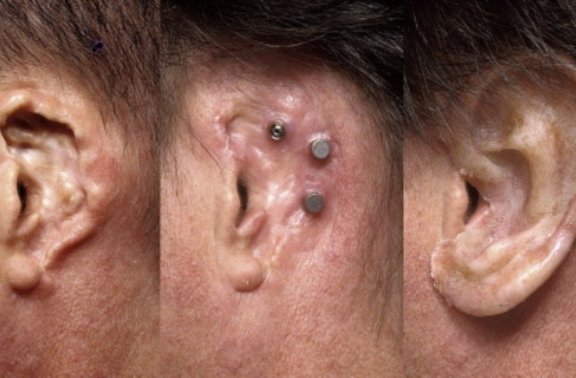 Ear Prosthesis