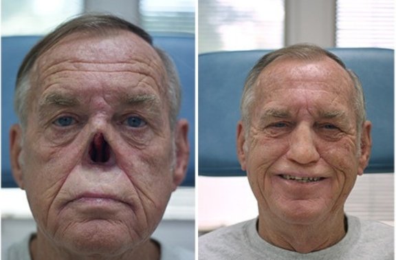 Nose Prosthesis